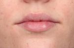 Lip Augmentation Case 2 After